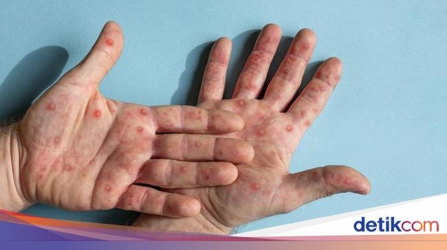 11 districts in north sumatra declared measles outbreak