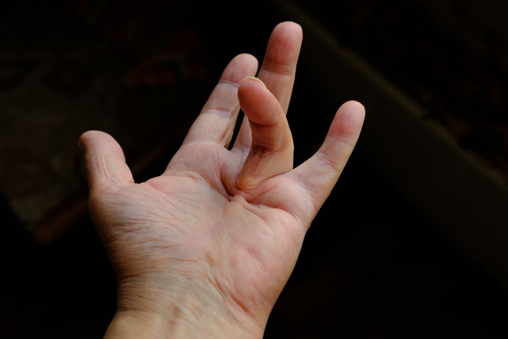 Why Dupuytren’s Disease is More Common in Northerners – The Answer Lies in Neanderthal Genes